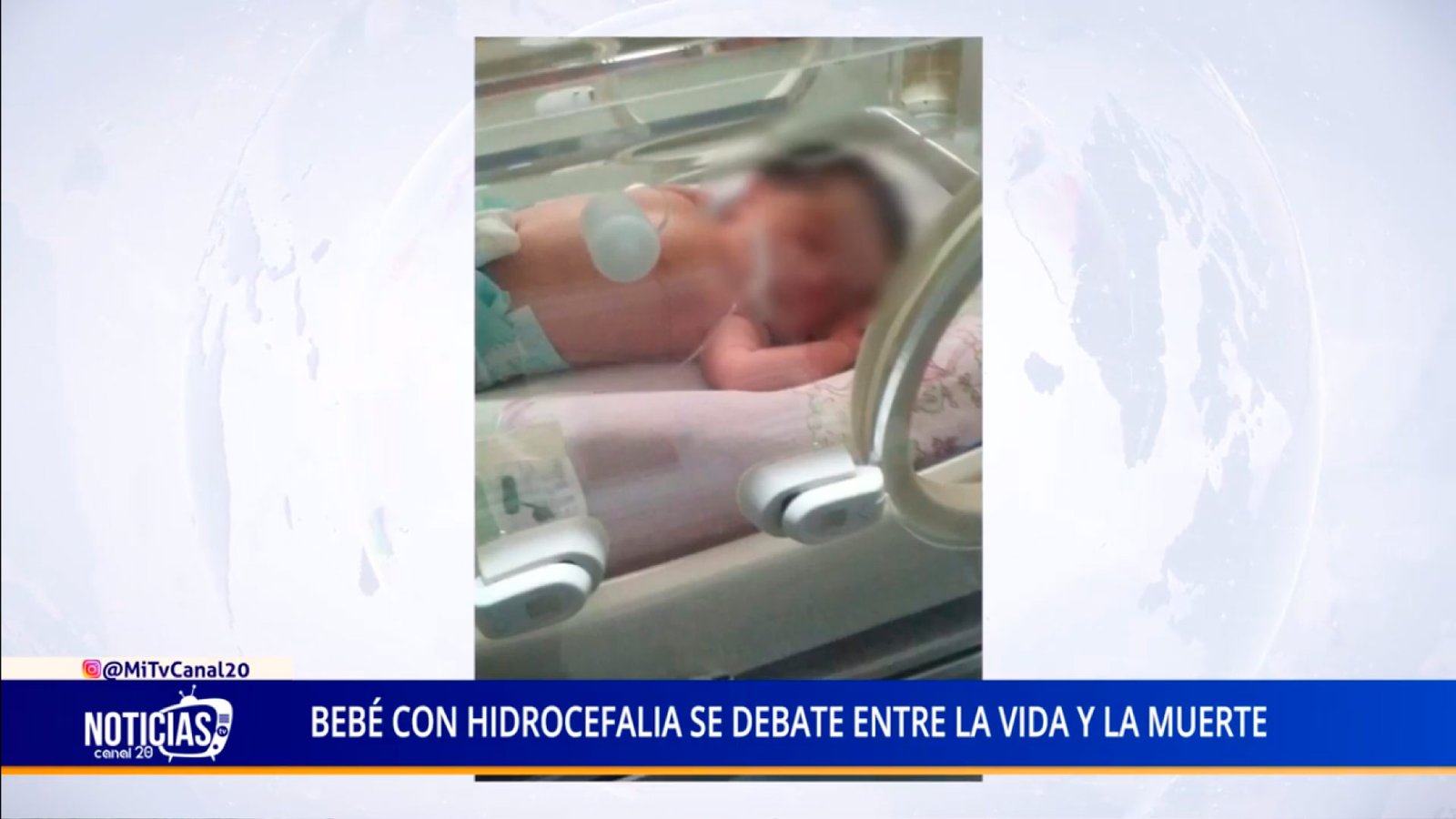 BEBÉ CON HIDROCEFALIA SE DEBATE ENTRE LA VIDA Y LA MUERTE